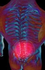 slipped disc New York Herniated Discs Lawyer