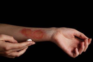 New York scarring injury lawyer