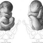 Erb's Palsy (Arm Palsy) Lawyer