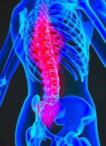 Spinal Cord Injury In an Accident